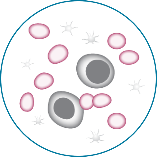 Bone Marrow From Healthy Patient and AML Patient part 1 of 6